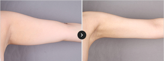 365mc BEFORE & AFTER